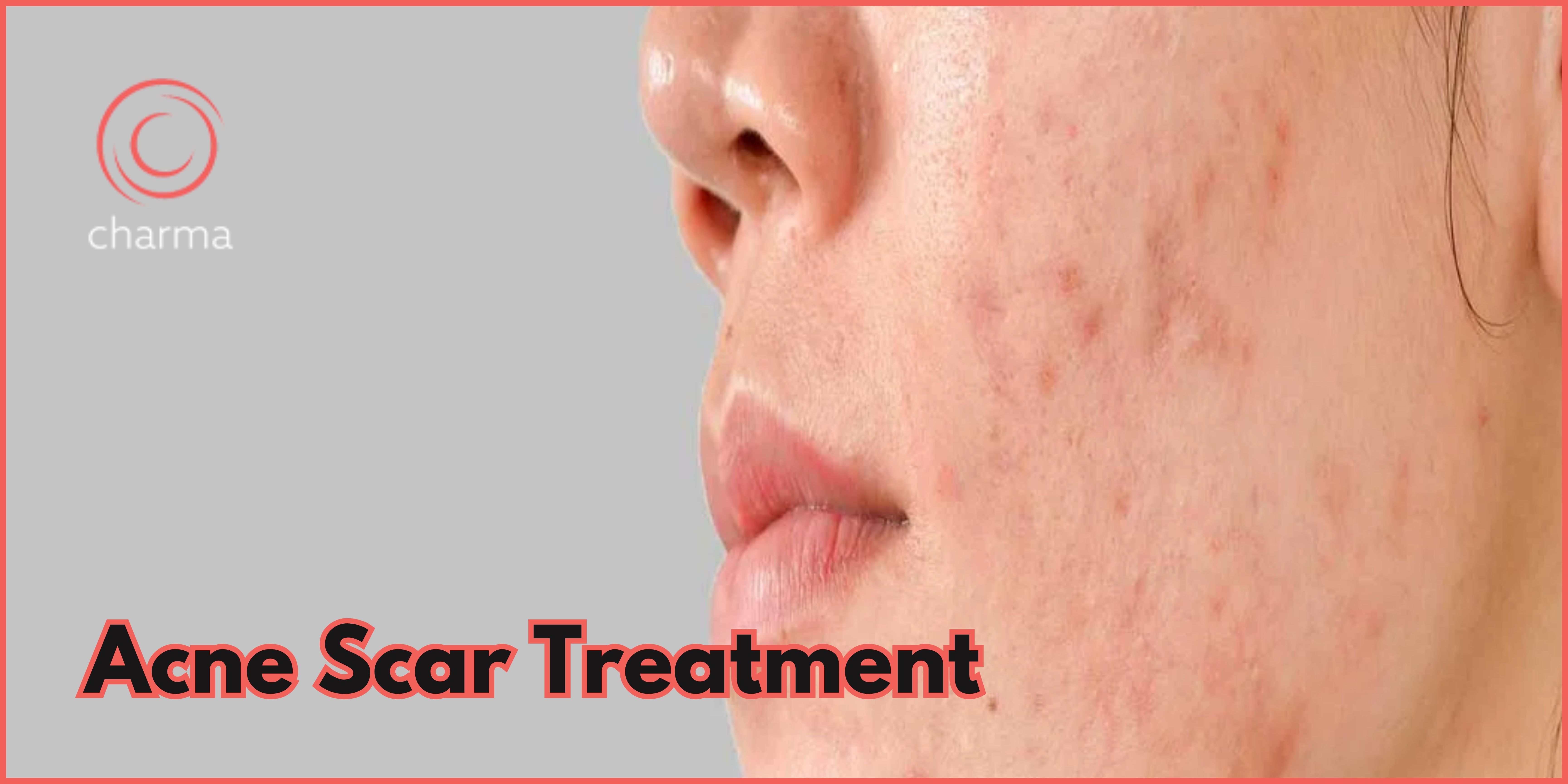 Acne Scar Treatment In Bangalore | Lowest Cost Estimate